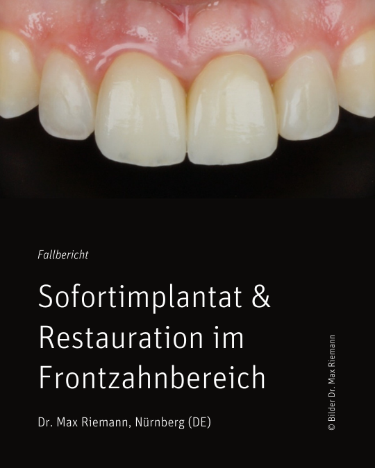 Zeramex XT: Individuelle volldigitale Lösung für hochästhetische Ergebnisse im Frontzahnbereich Zeramex XT: Individuelle volldigitale Lösung für hochästhetische Ergebnisse im Frontzahnbereich
