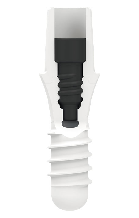 zeramex_implantatsystem_p6_verbindung_implantat_vicarbo_schraube_schnittansicht_456x715px Systembild ZERAMEX® P6 Implantat mit VICARBO® Schraube in der Schnittansicht