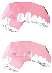 zeramex_implantatsystem_xt_p6_t_prothetik_einzelnzahn_brueckenversorgung_224x312px Systembild einer Einzelnzahn- und Brueckenversorgung an einem Kiefermodell - Illustration
