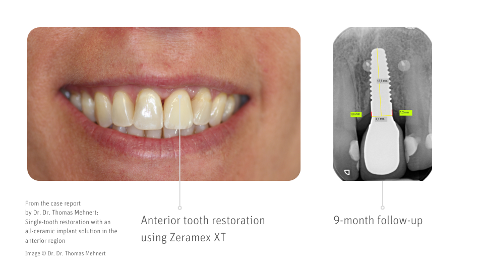 Zirconia implants