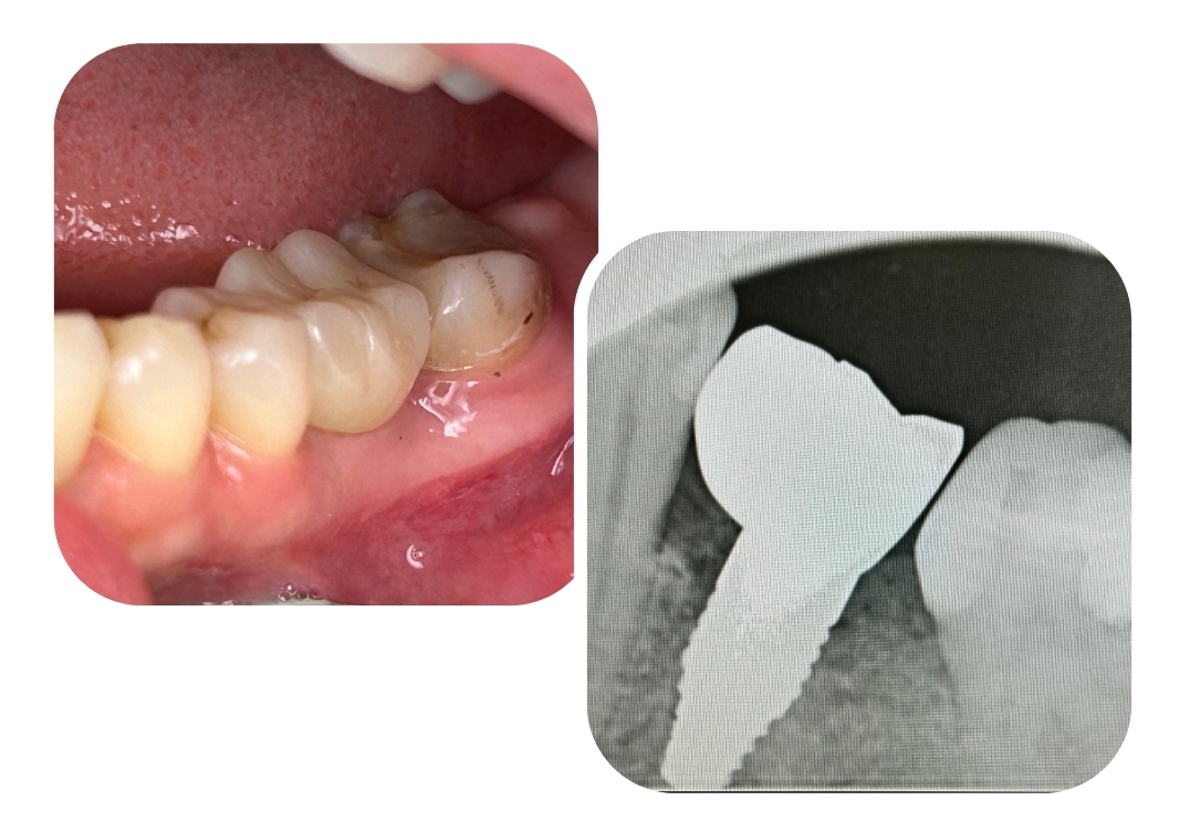 Molar implant