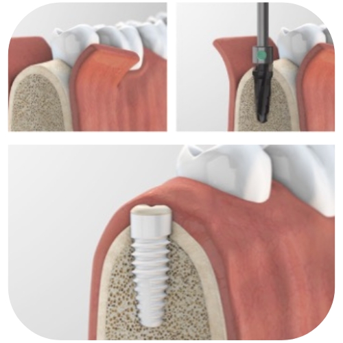 Zahnimplantate: Implantation