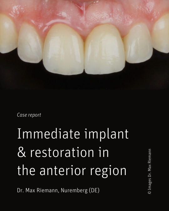 Zeramex XT: Individuelle volldigitale Lösung für hochästhetische Ergebnisse im Frontzahnbereich