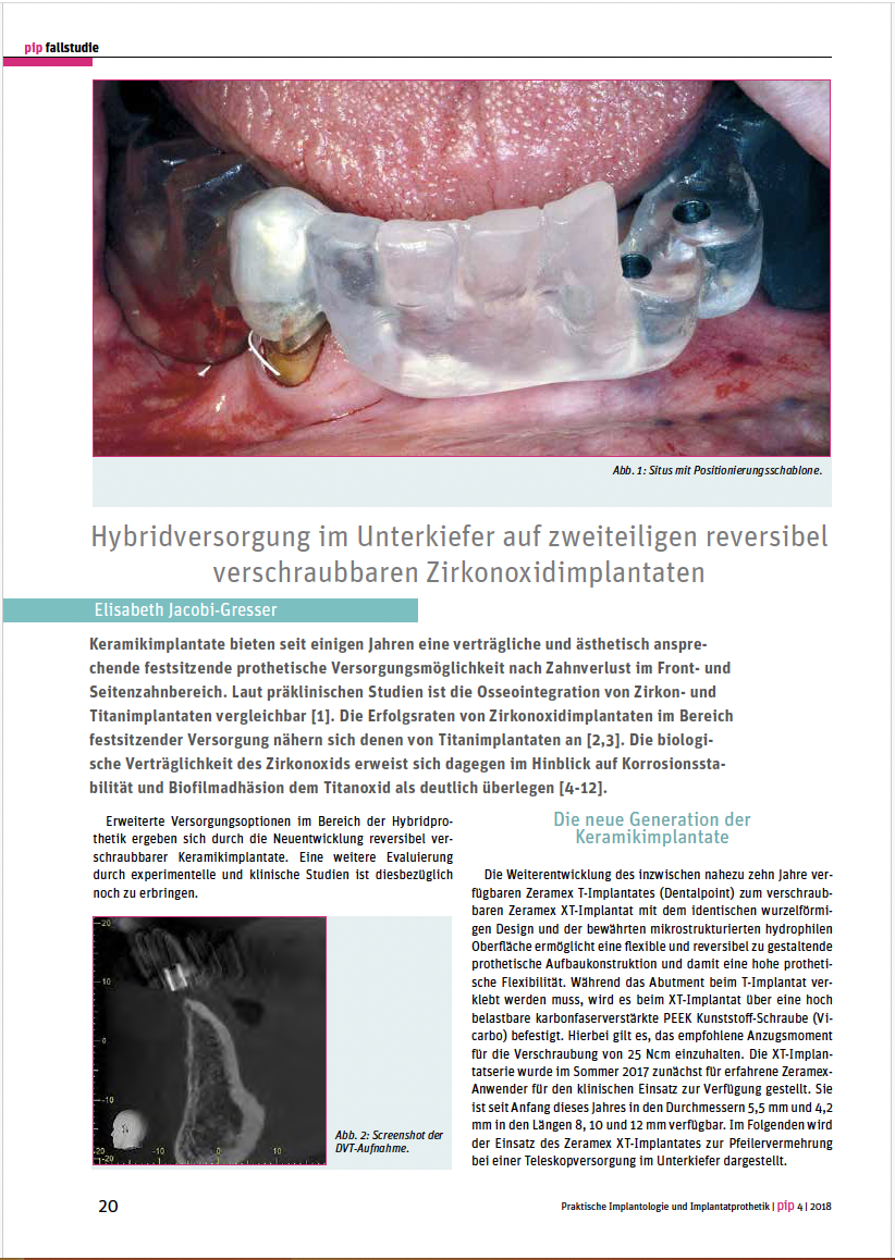 Hybridversorgung im Unterkiefer auf zweiteiligen reversibel verschraubbaren Zirkonoxidimplantaten – Dr. Elisabeth Jacobi-Gresser Hybridversorgung im Unterkiefer auf zweiteiligen reversibel verschraubbaren Zirkonoxidimplantaten – Dr. Elisabeth Jacobi-Gresser