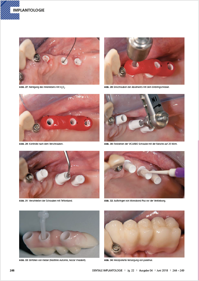 Brücke auf Keramikimplantaten im Seitenzahnbereich – Dr. Michael Leistner Brücke auf Keramikimplantaten im Seitenzahnbereich – Dr. Michael Leistner