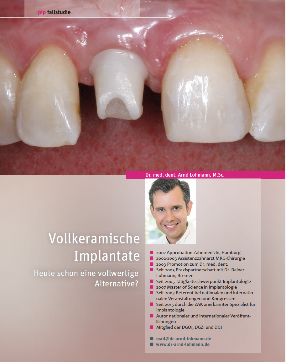 Vollkeramische Implantate: Heute schon eine vollwertige Alternative? – Dr. Arnd Lohmann Vollkeramische Implantate: Heute schon eine vollwertige Alternative? – Dr. Arnd Lohmann