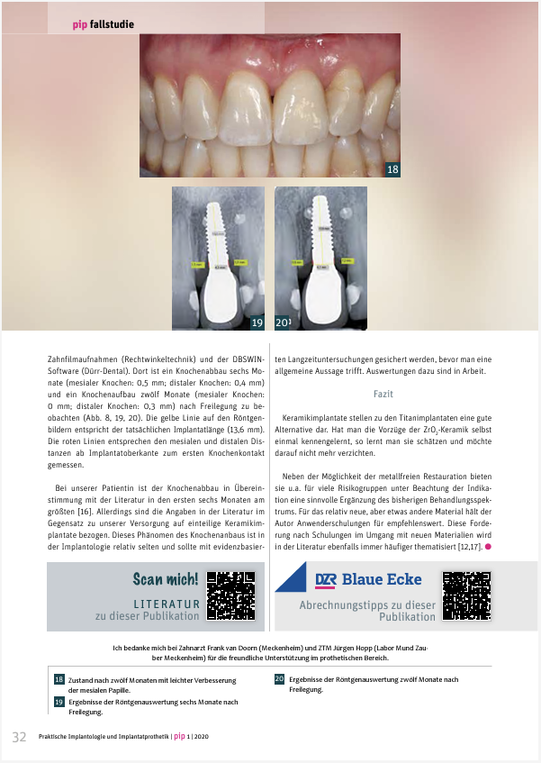 Einzelzahnversorgung mit einer vollkeramischen Implantatlösung im Frontzahnbereich – Dr. Dr. Thomas Mehnert Einzelzahnversorgung mit einer vollkeramischen Implantatlösung im Frontzahnbereich – Dr. Dr. Thomas Mehnert