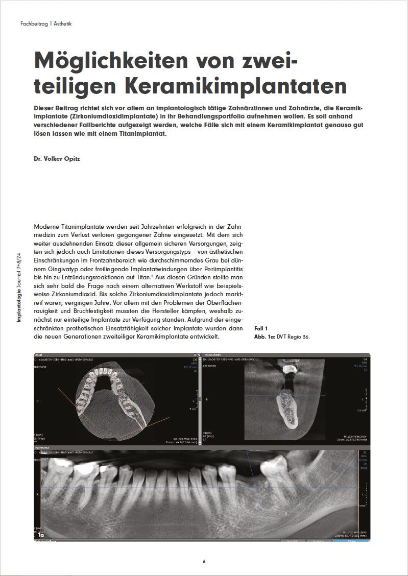 Möglichkeiten von zweiteiligen Keramikimplantaten – Dr. Volker Opitz Möglichkeiten von zweiteiligen Keramikimplantaten – Dr. Volker Opitz