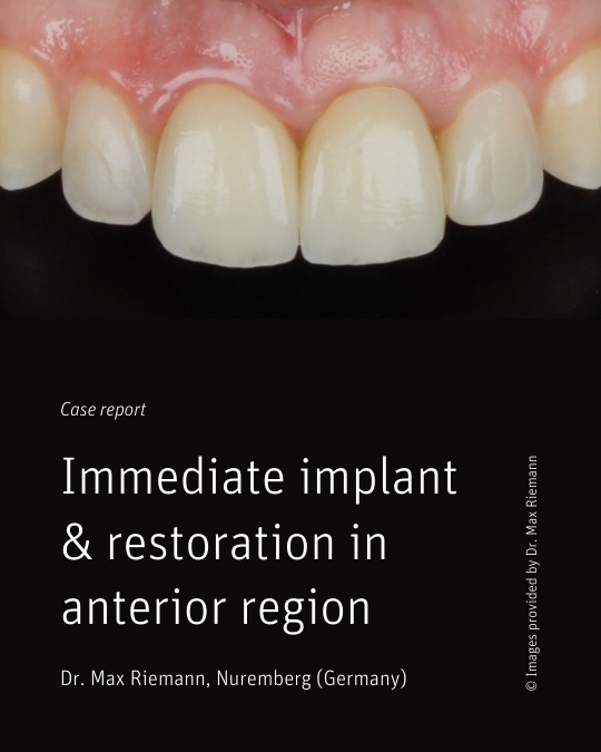 Immediate implant & restoration in the anterior region - Dr. Max Riemann