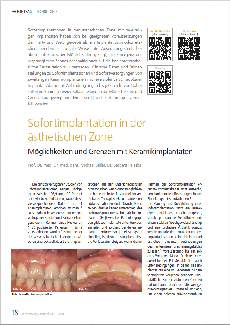 Sofortimplantation in der ästhetischen Zone: Möglichkeiten und Grenzen mit Keramikimplantaten Sofortimplantation in der ästhetischen Zone: Möglichkeiten und Grenzen mit Keramikimplantaten