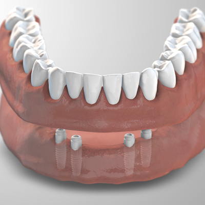 Keramikimplantate Zeramex XT Docklocs® Abutments