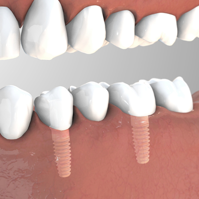 Zirconia implants Zeramex XT