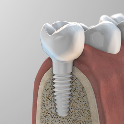 Keramikimplantate Zeramex XT mit monolithischer Krone