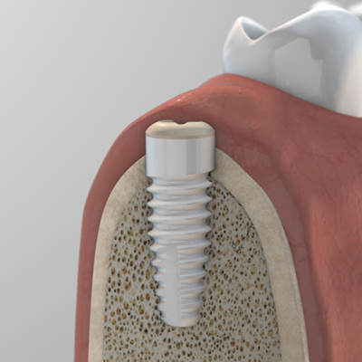 Impianti in ceramica Zeramex XT e cappetta di guarigione