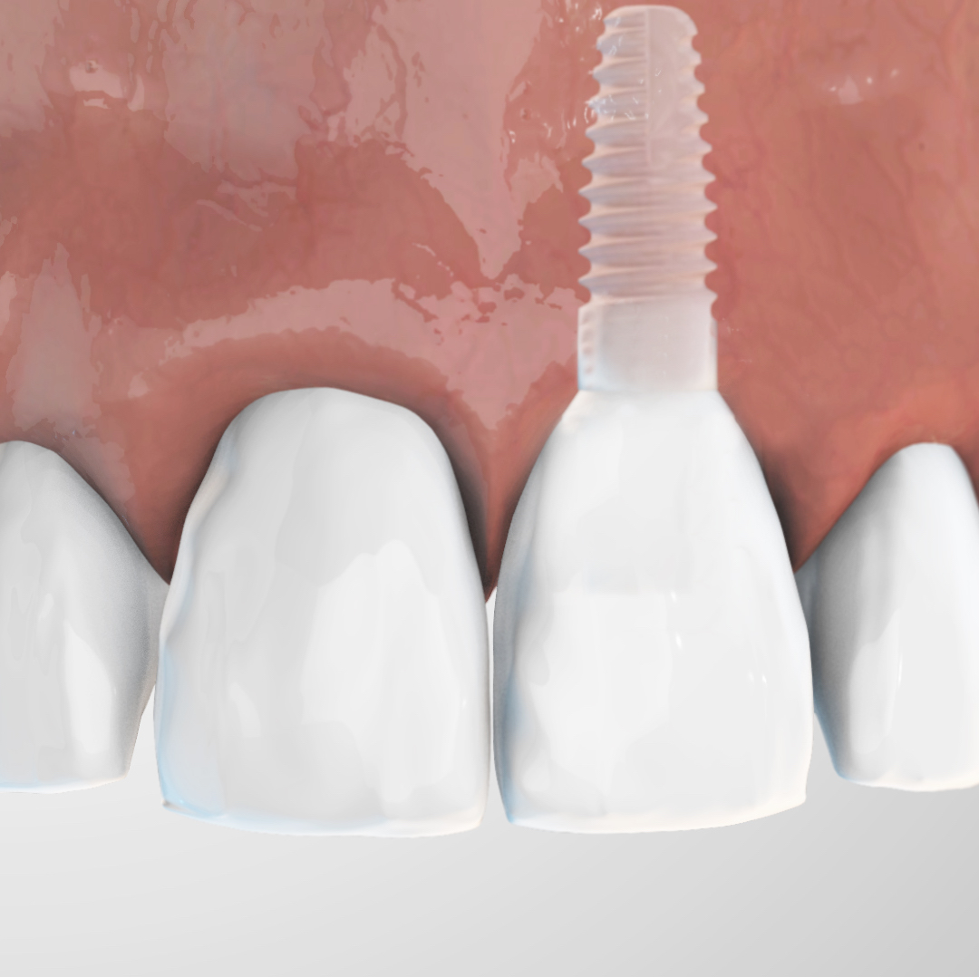 Impianto dentale in ceramica Zeramex XT