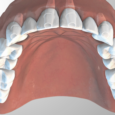 Ceramic dental implants