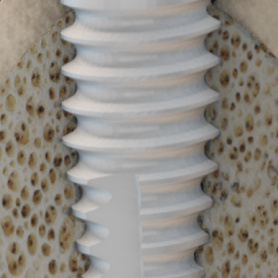 Zirconia implants Zeramex XT- Zerafil surface