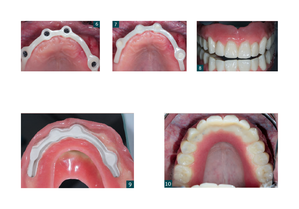 Zahnimplantate Zeramex XT