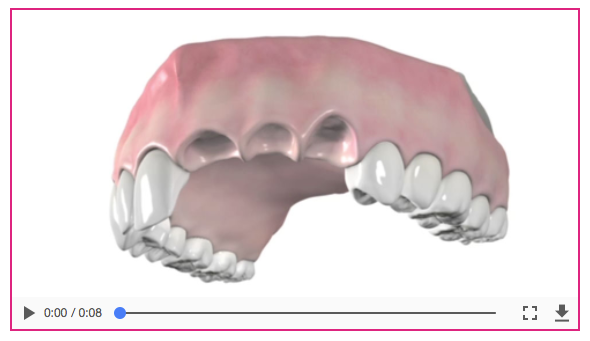 Dental implants