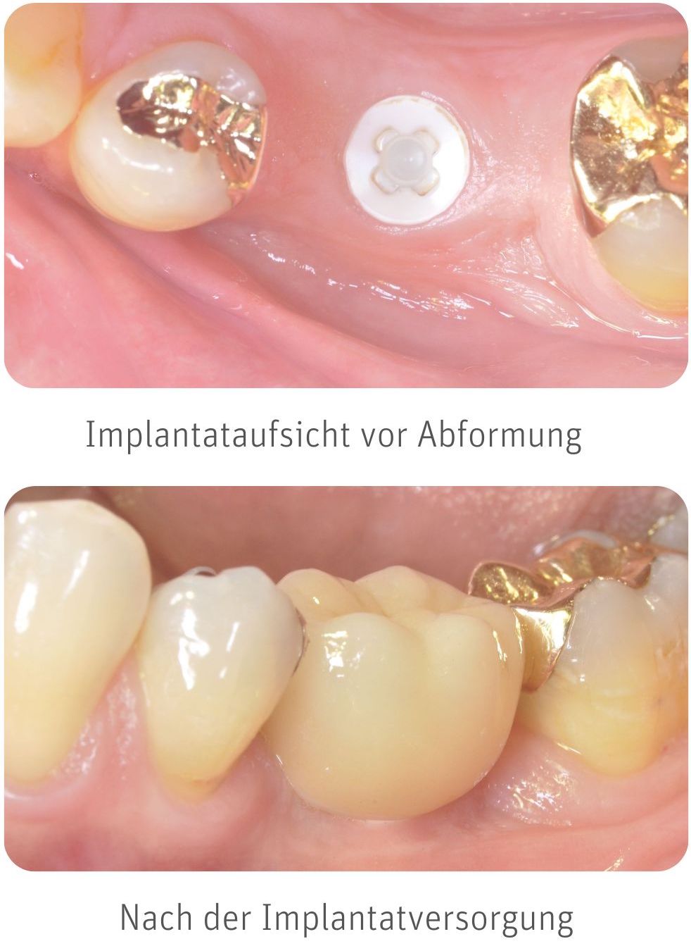 Implantat Erfahrungen Implantat Erfahrungen