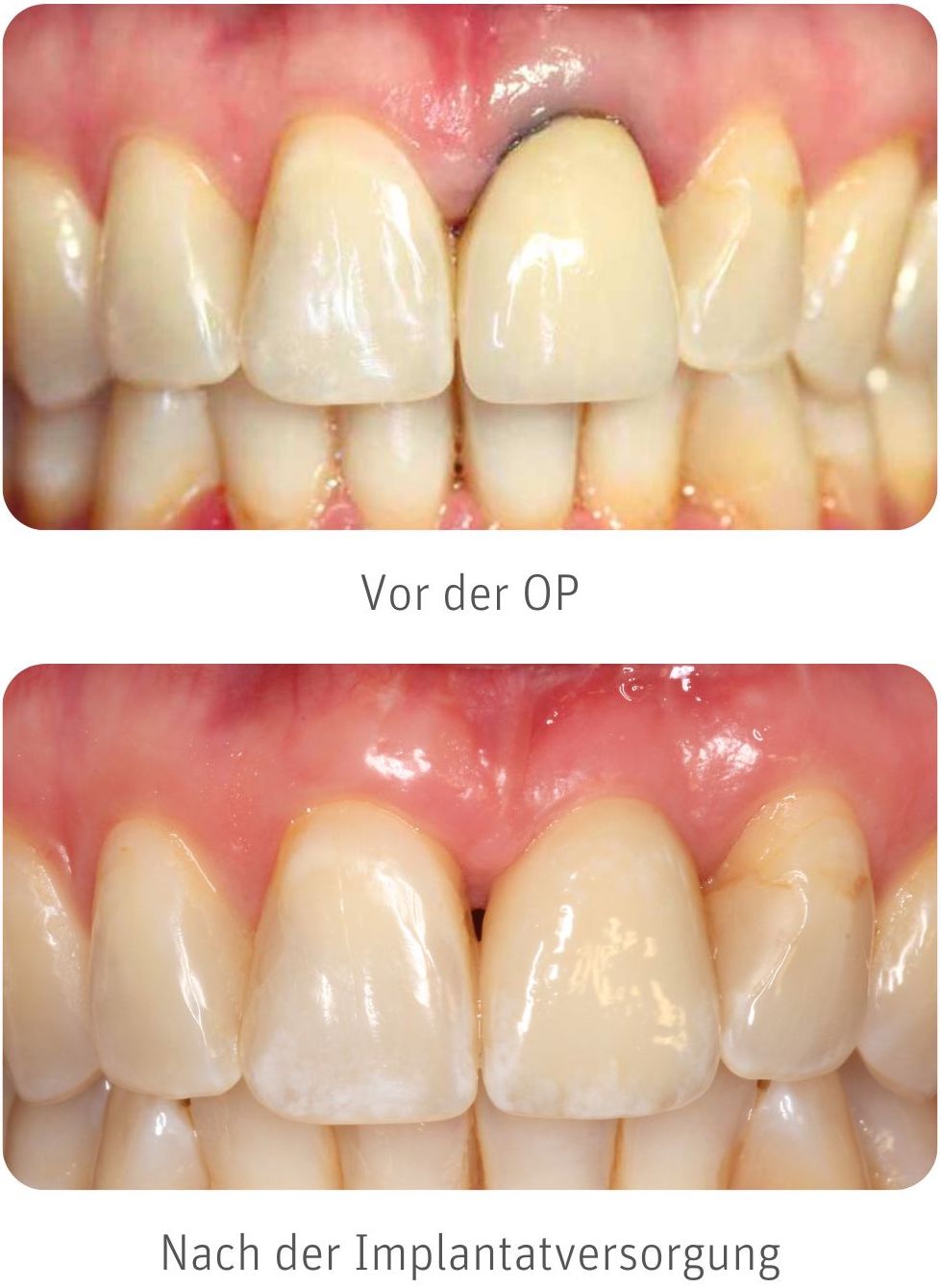 Zahnimplantat Erfahrungen Zahnimplantat Erfahrungen