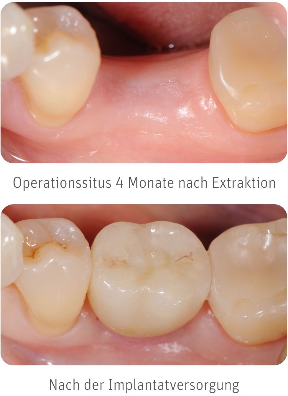Zahnimplantat Erfahrungen Zahnimplantat Erfahrungen