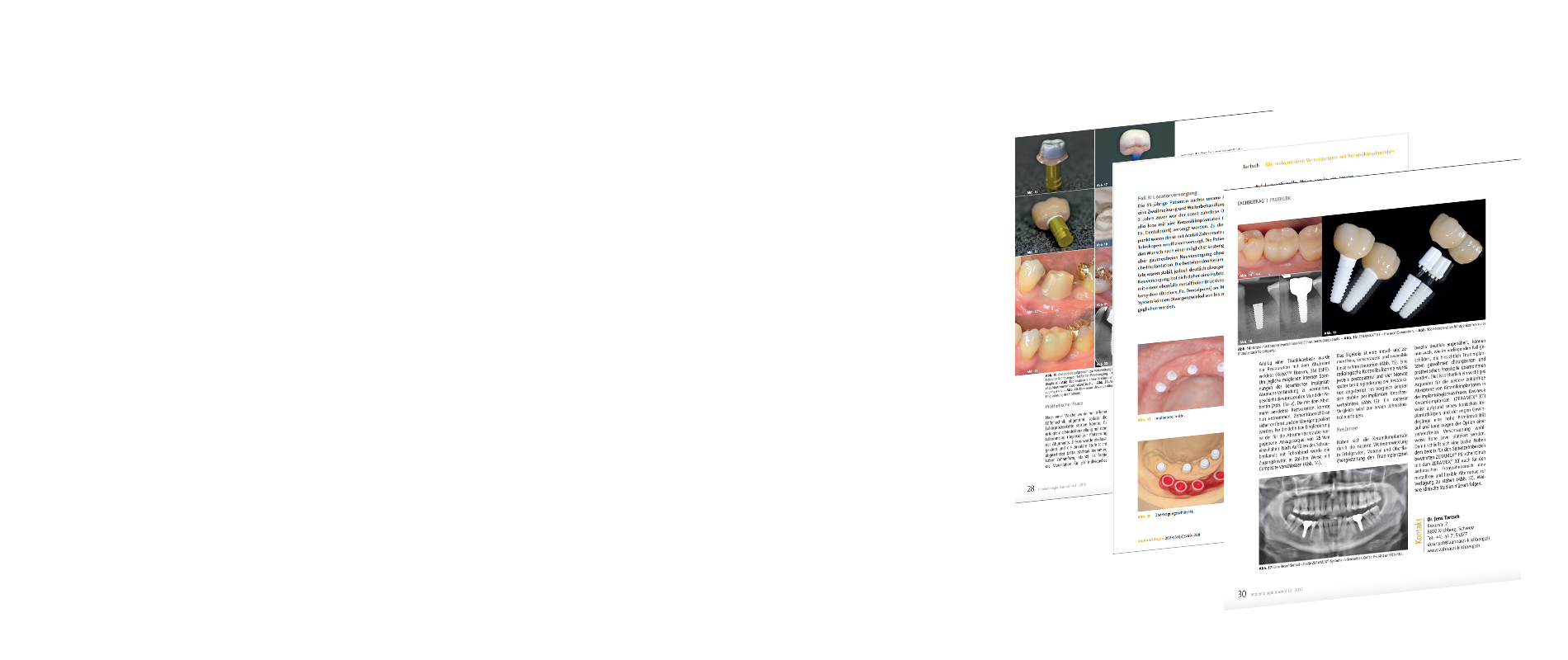 Implantate Erfahrungen | Zahnimplantate Erfahrungen Implantate Erfahrungen | Zahnimplantate Erfahrungen