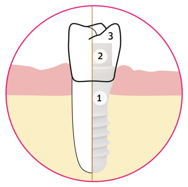 Illustration eines Vergleichs Zahnimplantat und natürlicher Zahn