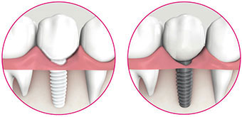 System image comparison ceramic implant and metal implant